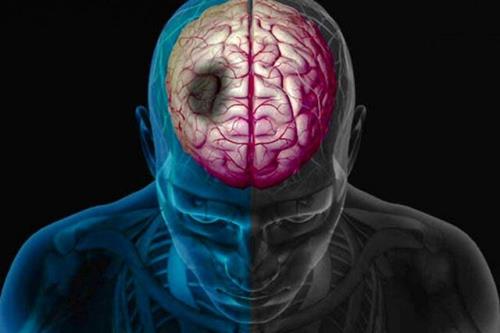علایم سکته مغزی چیست؟