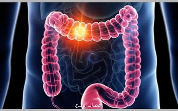 عوامل موثر در بروز سرطان روده
